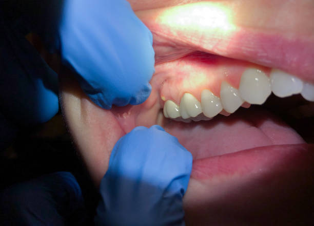 Best Chipped Tooth Repair Near Me  in Orem, UT